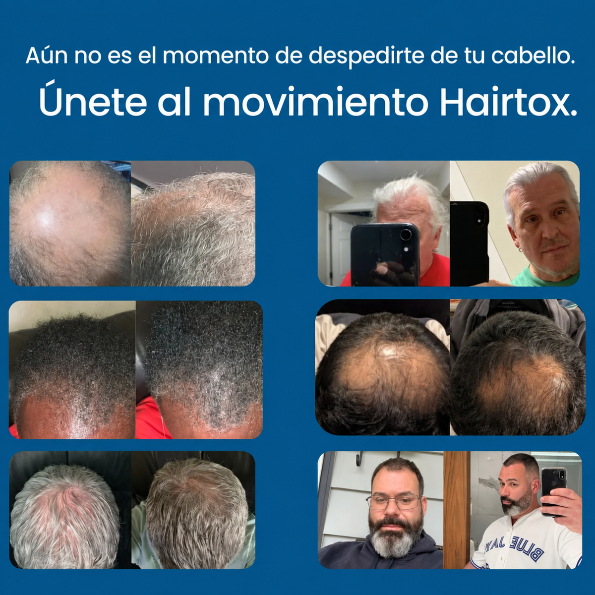 El sistema de infusión de péptidos más potente para el crecimiento del cabello